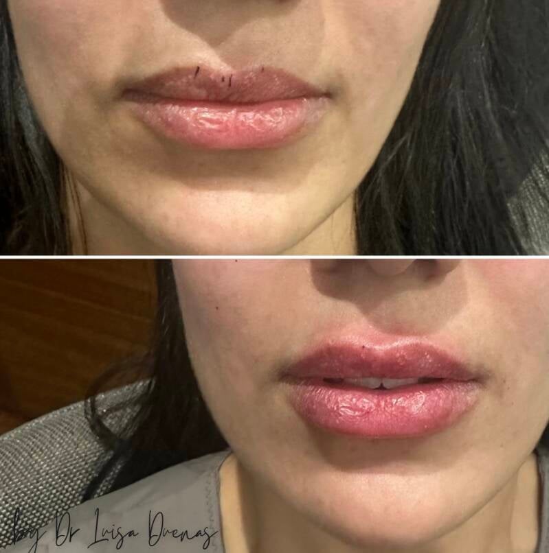 Lips Filler