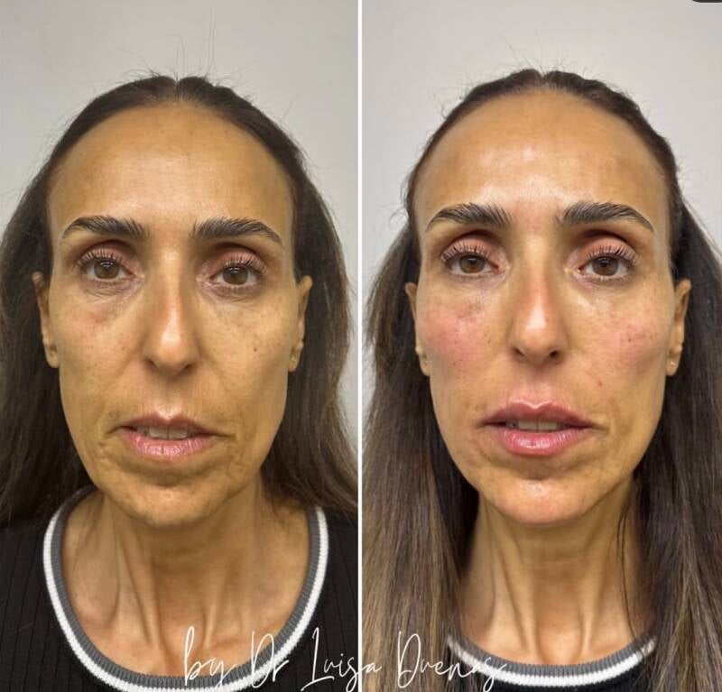 Facial Harmonisation 