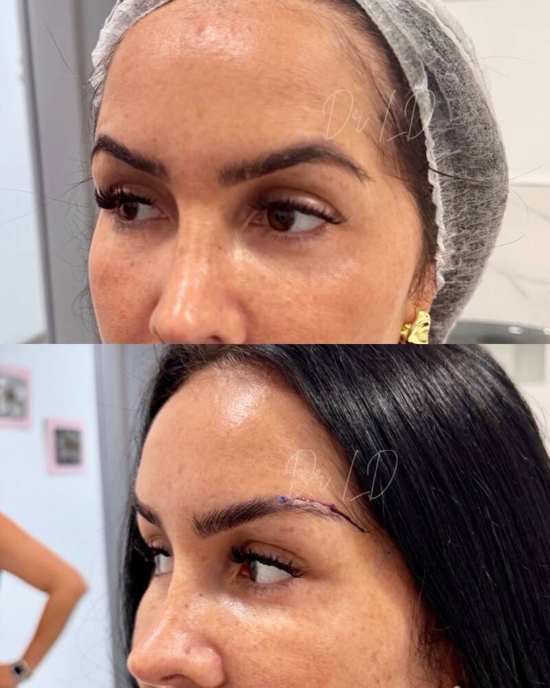 Lifting lateral de cejas