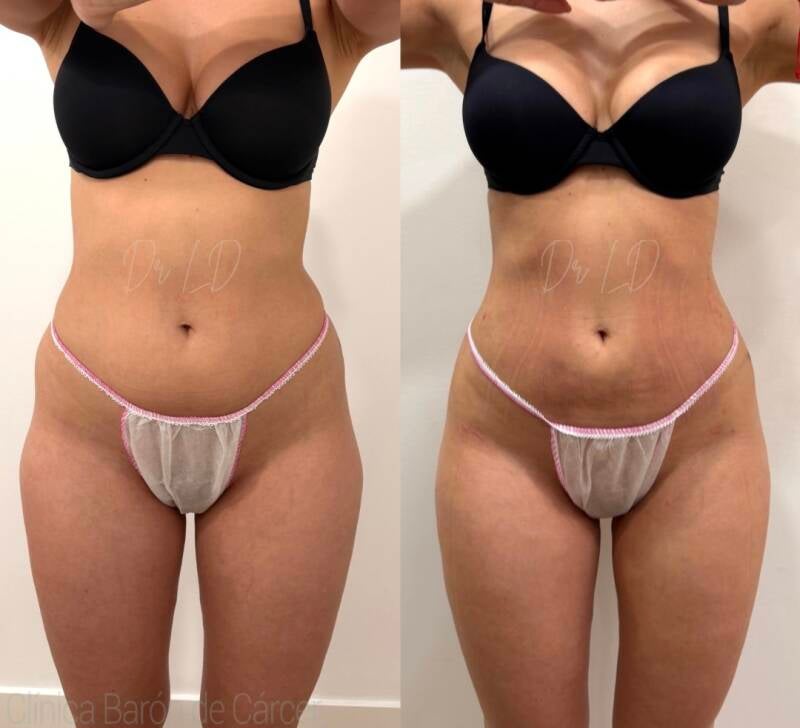 Mini lipo flancos y abdomen