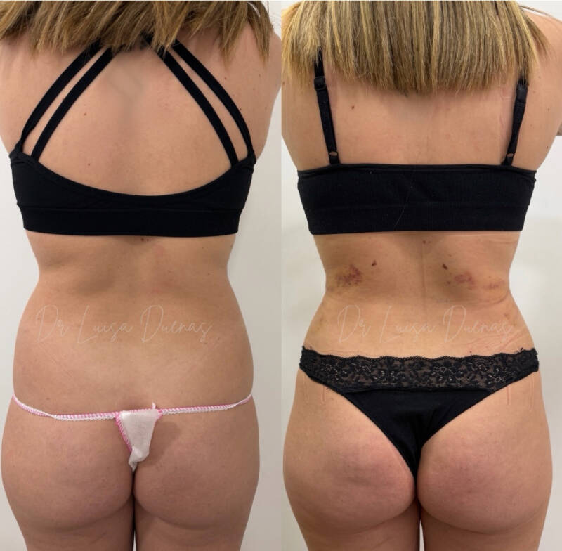 Mini lipo Flancos