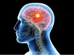 BDSM na een herseninfarct 