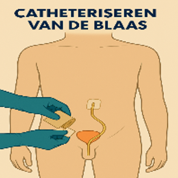 Catheteriseren van de blaas bij mannen