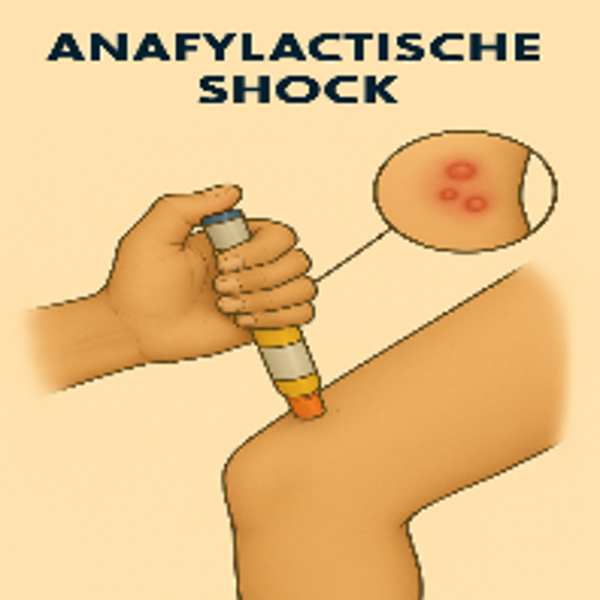 Anafalactische Shock