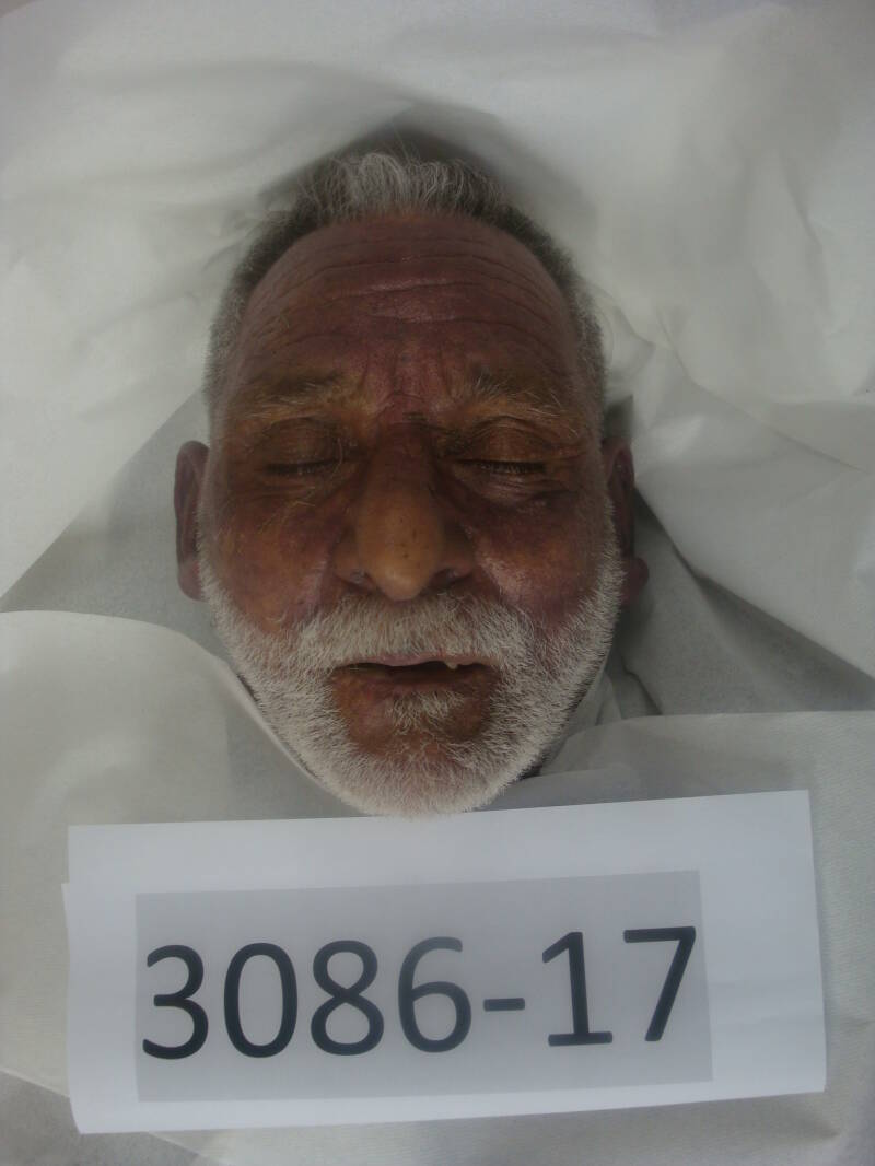 John D. Ciales, PR amputated left leg June 24, 2017