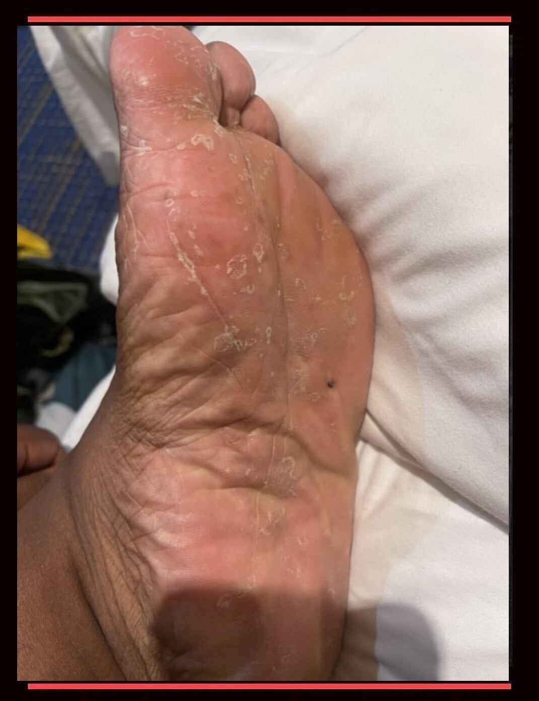 Up-close side view of a Black man's soles, showing how dried, cracked, and damaged his heels and soles are from lack of foot care and moisturizing. A perfect example of rough uncle feet