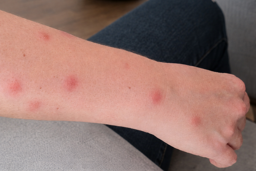 Avant-bras présentant plusieurs lésions rouges groupées, compatibles avec des piqûres d’insectes nocturnes.