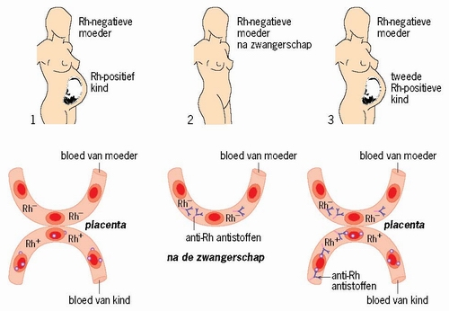 Rhesus D reactie.