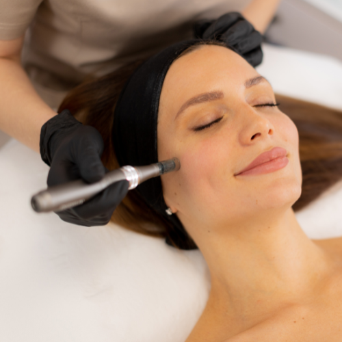 alt="Microneedling behandeling bij Skintime voor huidverjonging"