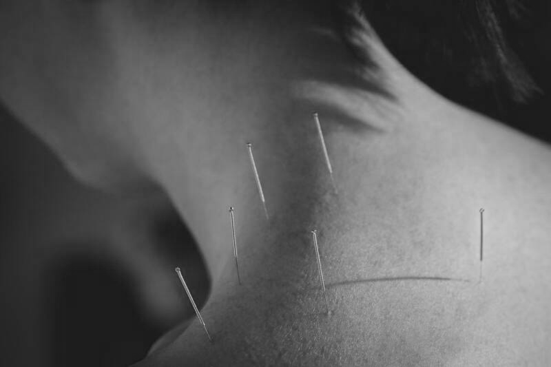 Acupuntuur behandeling met naalden