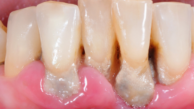 Penyakit gusi gingivitis yang boleh dicegah dengan scaling gigi berkala