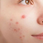 Acne zwanger tips