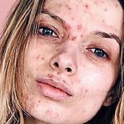 Acne 3-4 graad vette huid tips