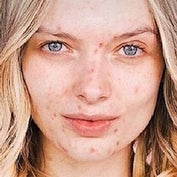 Acne 1-2 graad vette huid tips