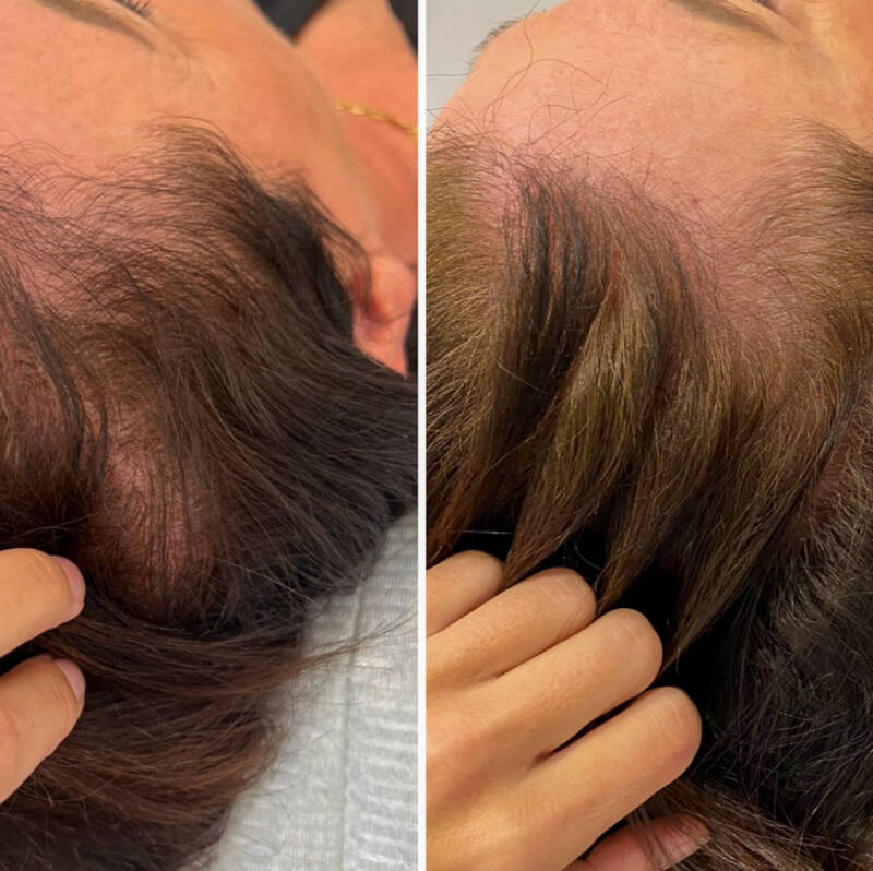 Kaalheid behandeling Gouda