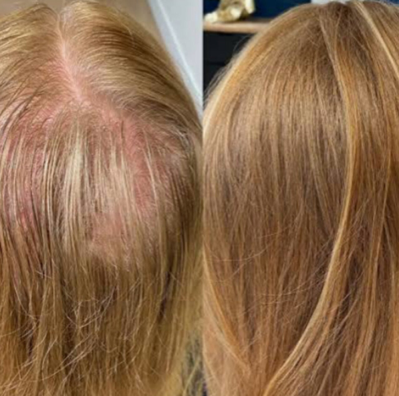 Alopecia behandeling Gouda