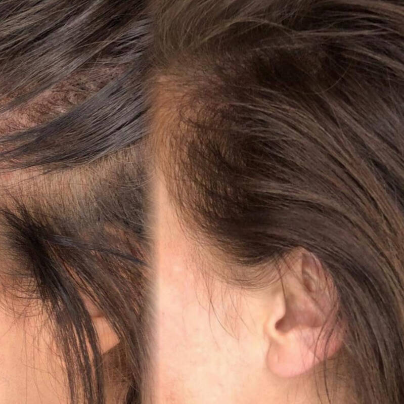 Scalp kuur