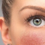 Rosacea tips