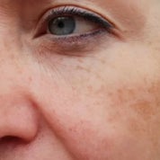 Hyperpigmentatie Rimels tips