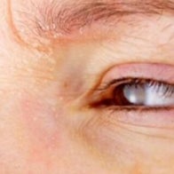 Droge schilferige huid tips