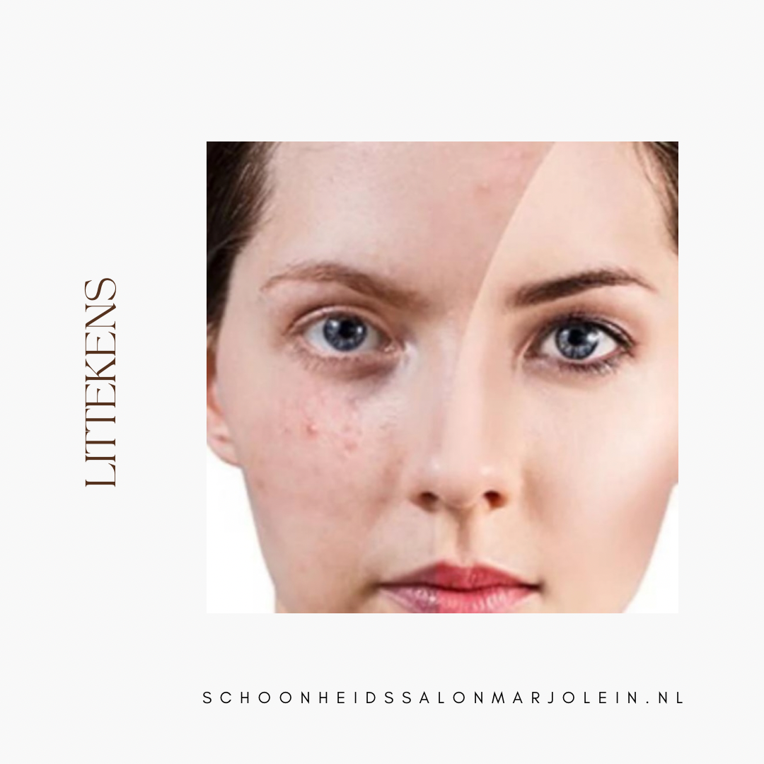 Littekens behandeling