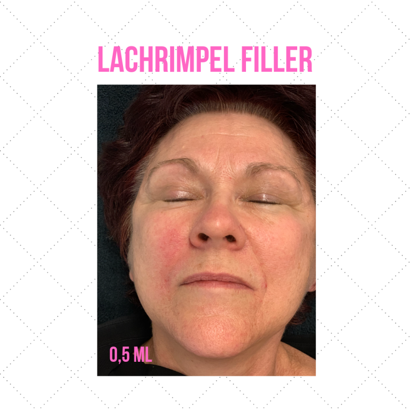 hyaluron pen maarssen fillers zonder naald utrecht