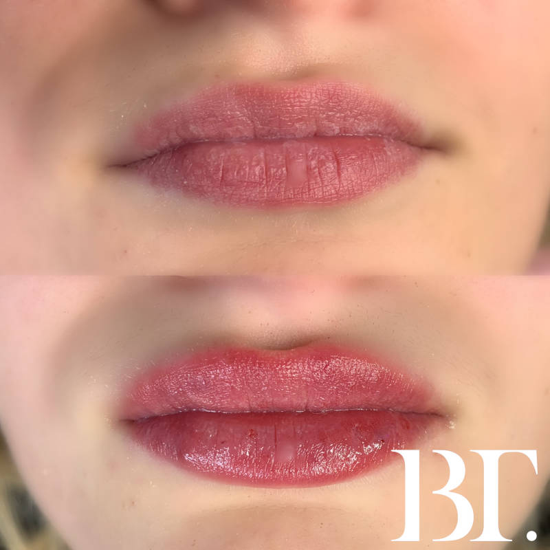 hyaluronpen fillers zonder naald maarssen utrecht