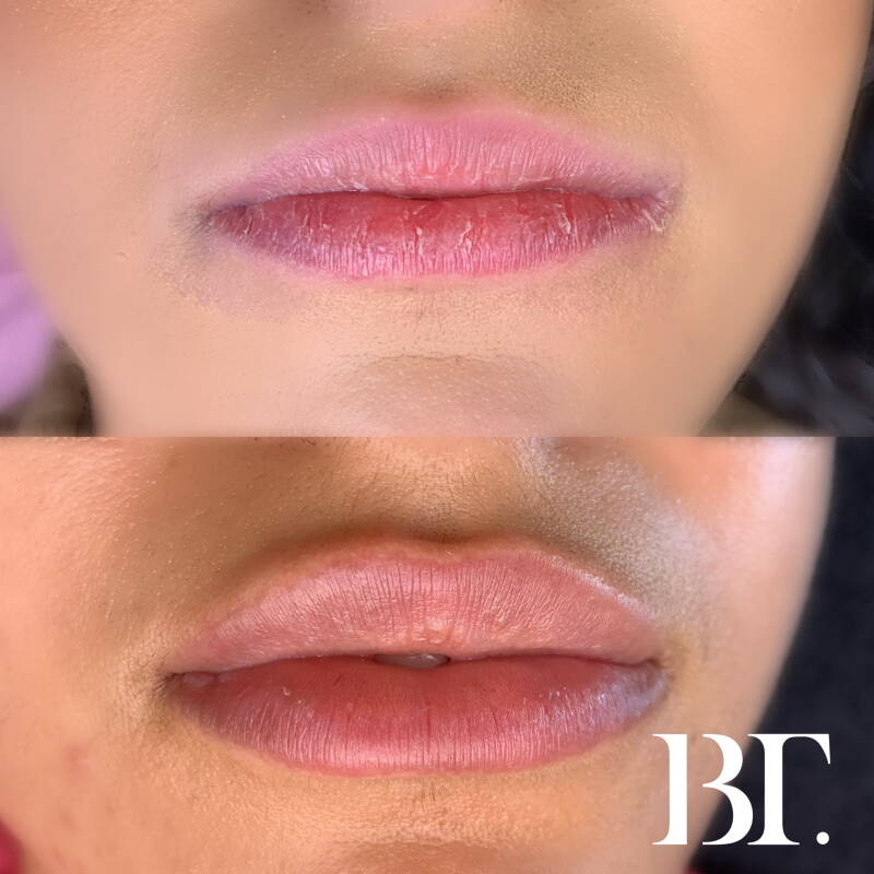 lipfillers zonder naald maarssen utrecht de meern lipfillers beautytrendutrecht