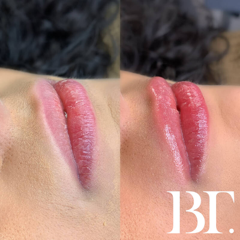 lipfillers zonder naald maarssen utrecht de meern lipfillers beautytrendutrecht