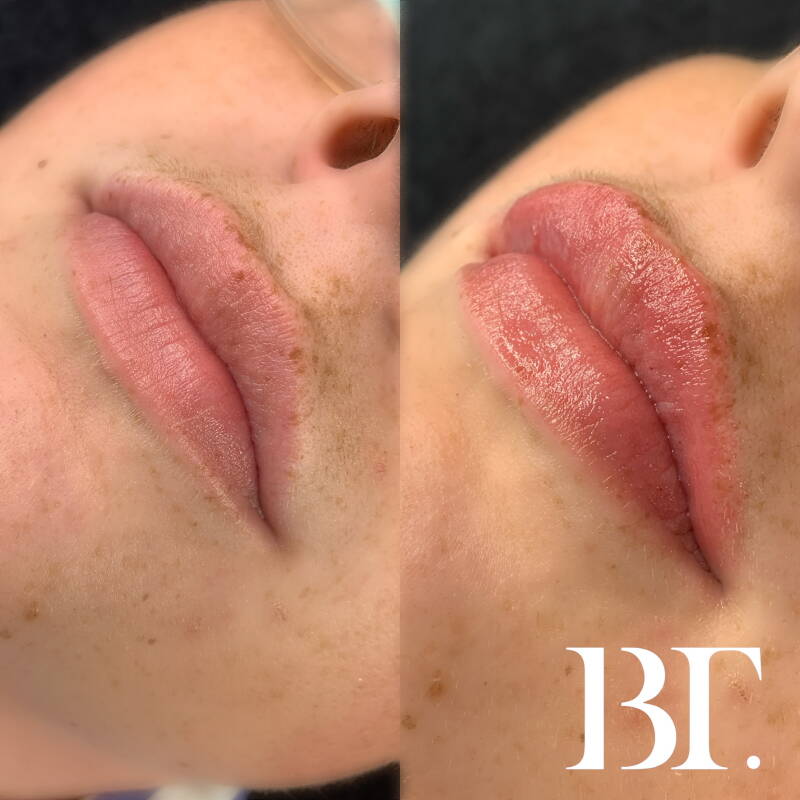 hyaluron pen maarssen fillers zonder naald utrecht