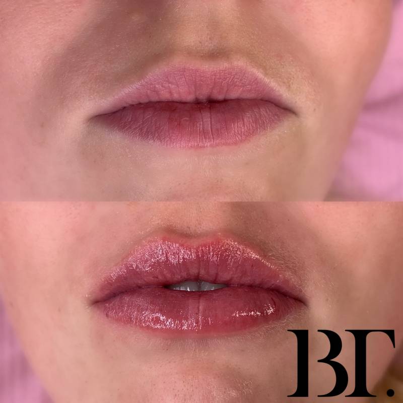 hyaluronpen fillers zonder naald maarssen utrecht