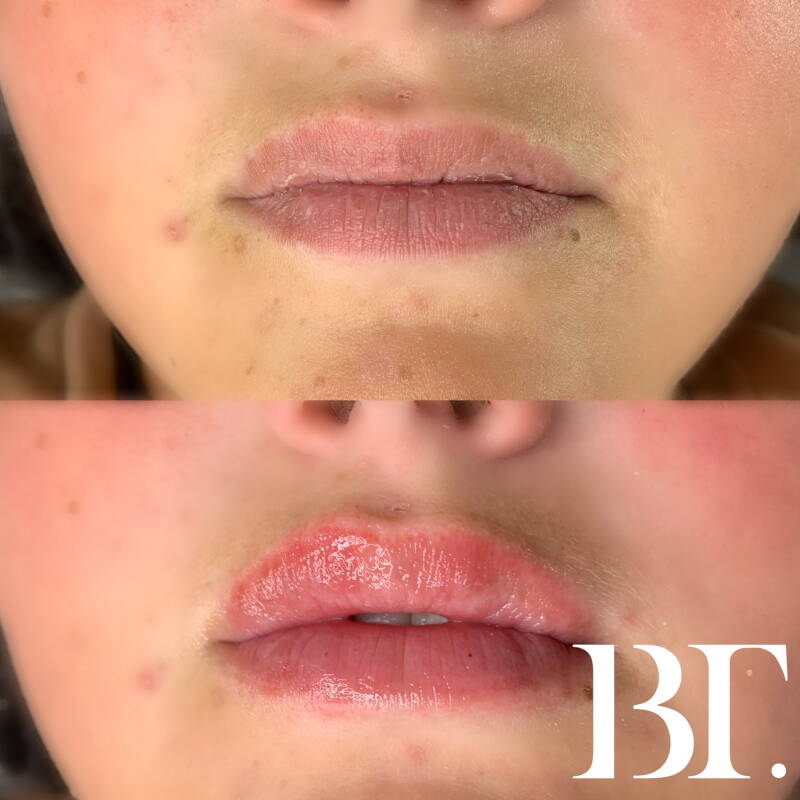 fillers zonder naald hyaluronpen maarssen utrecht hyaluron pen pijnloos veilig