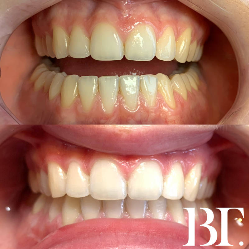 tanden bleken schadevrij de meern utrecht maarssen pijnloos tanden bleken teeth whitening utrecht