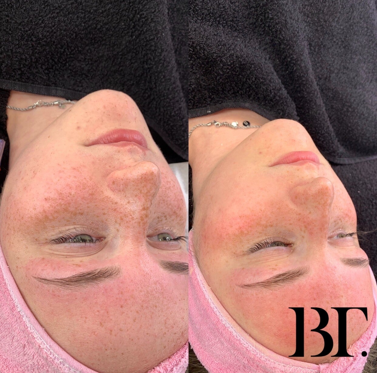 bb glow maarssen/maarssenbroek microneelding