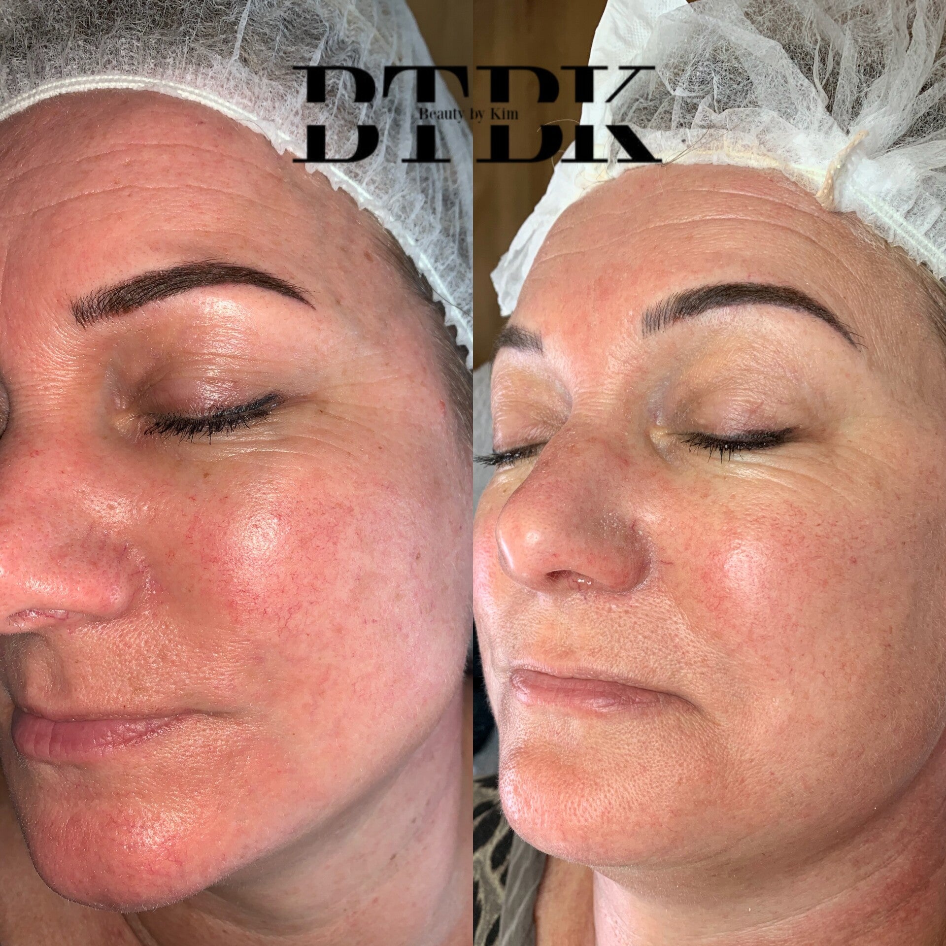 bb glow maarssen/maarssenbroek microneelding