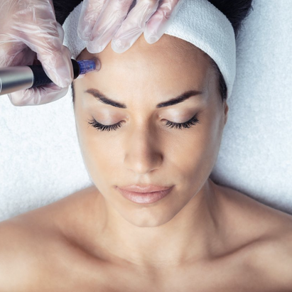 microneedling - mesotherapie