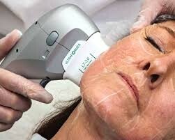 HiFU Non surgical face lift