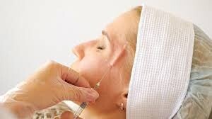 Brow, Temple and Piriform Fossa Filler