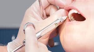 Dental Block (nerve numbing)