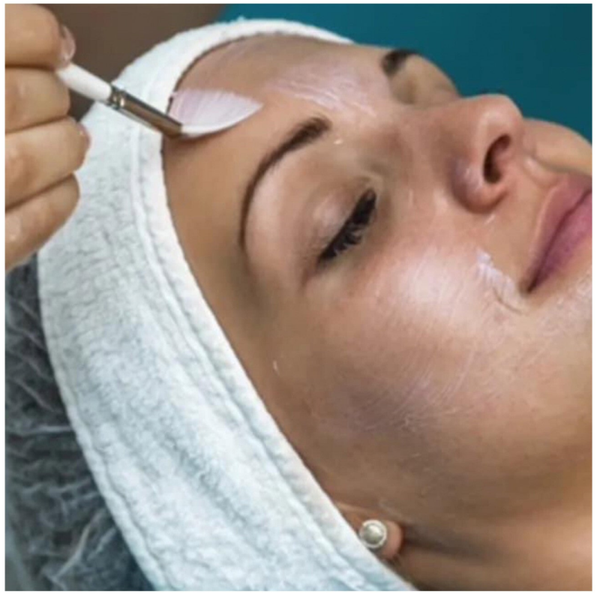 Chemical Peel