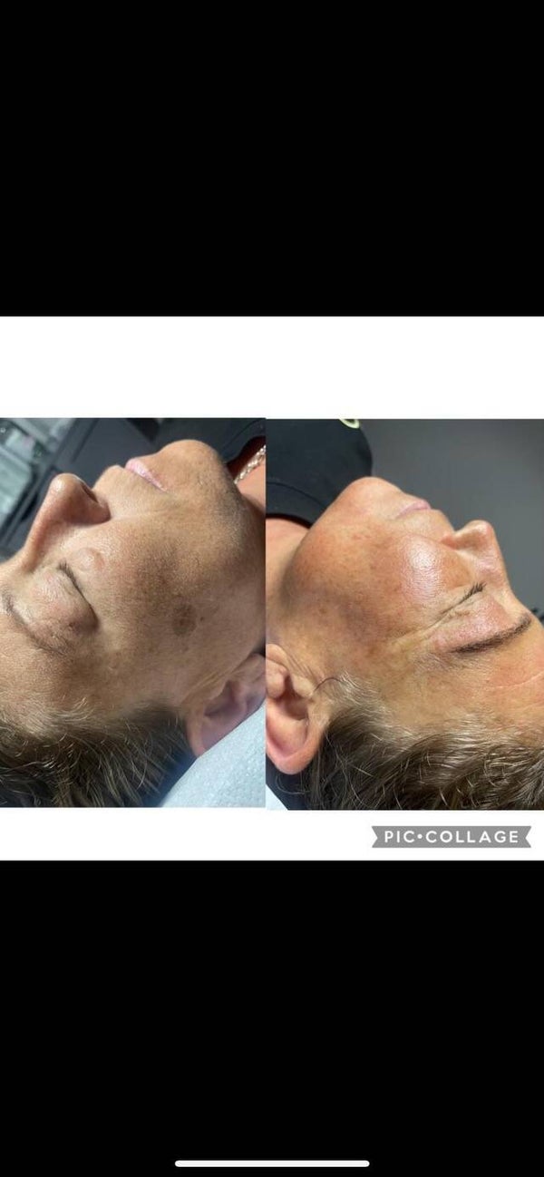 Million dollar facial
