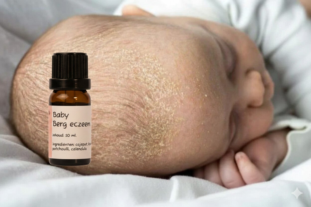 Baby Berg eczeem