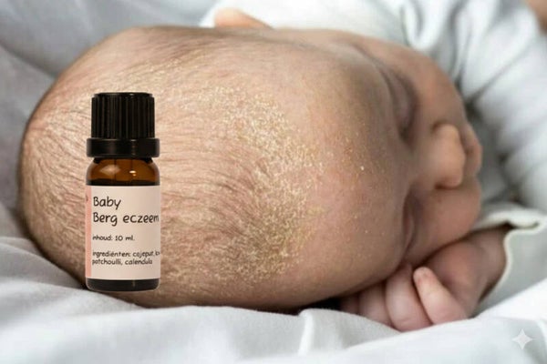 Baby Berg eczeem