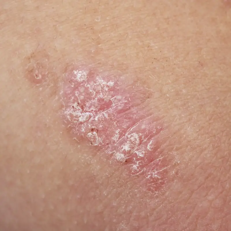 Psoriasis en etherische olie