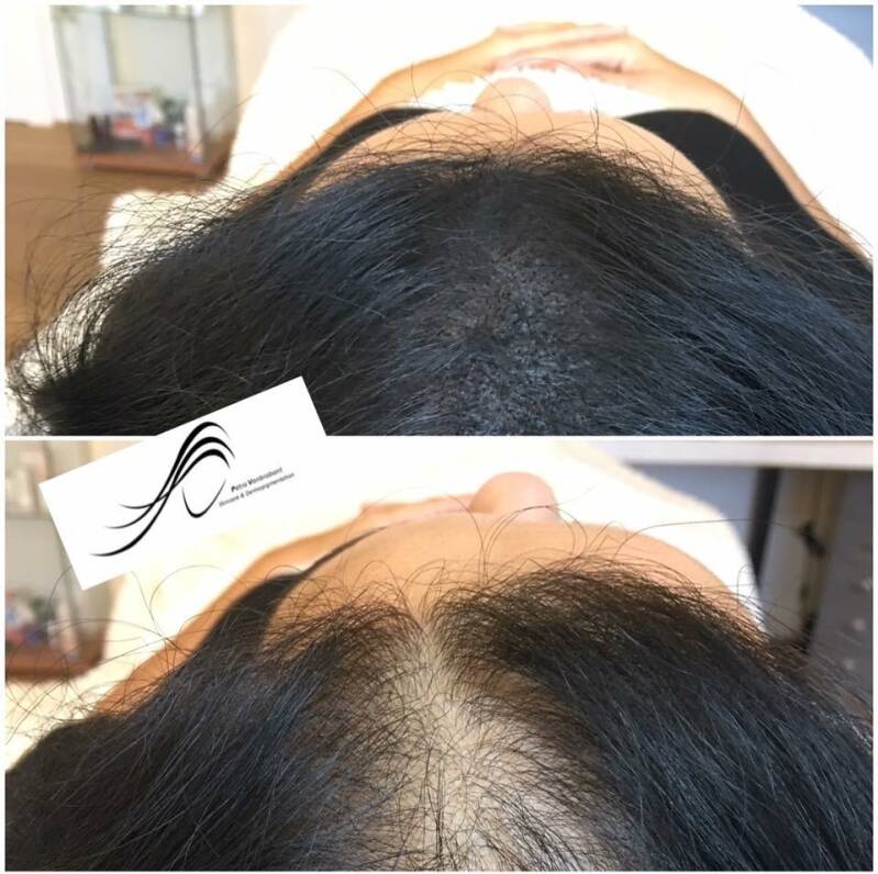 hairscalppigmentatie mannen vrouwen haarverdichting