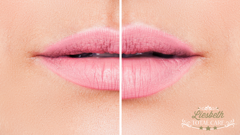 Lippen opspuiten Curaçau