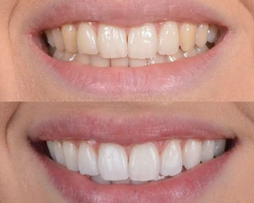 Blanqueamiento Dental