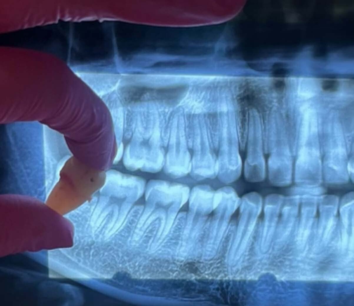 Cirugía Maxilofacial y Muelas del Juicio