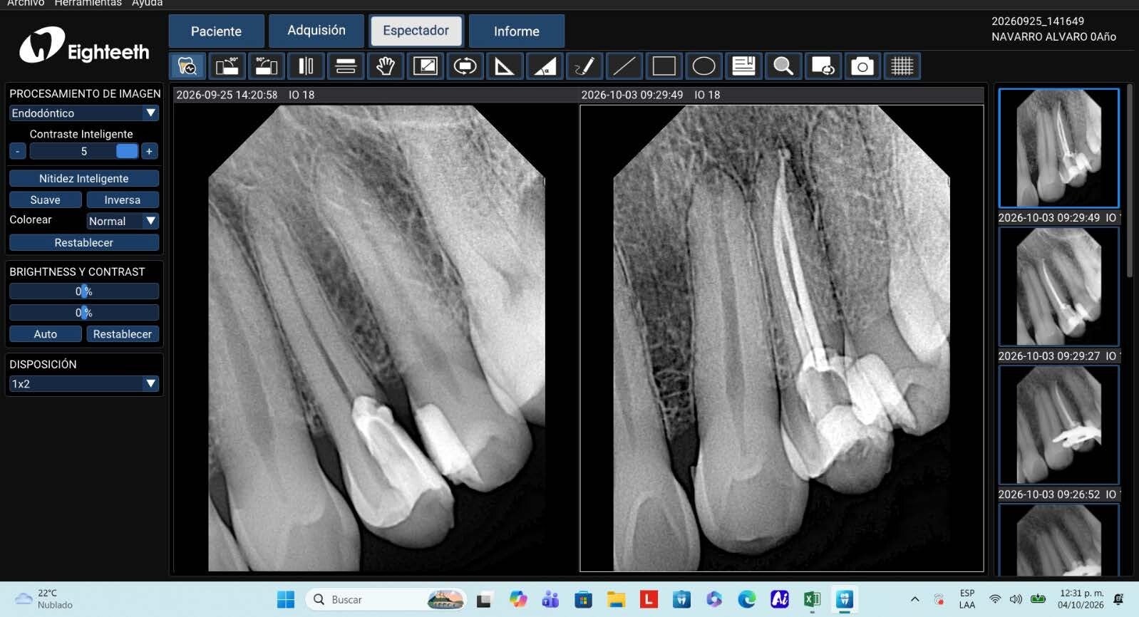 Tratamiento de Conductos y Endodoncia