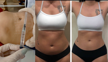 Mesoterapia Corporal